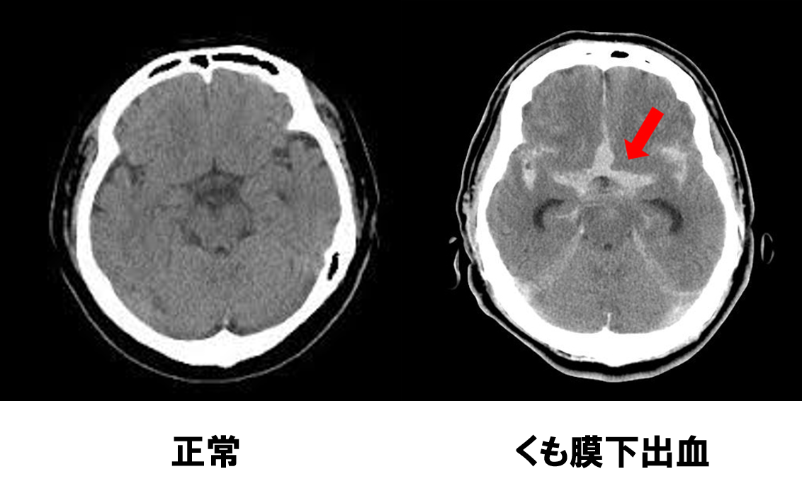 脳出血になったときの検査と診断は何をする？CTとMRI検査以外には？ | 脳卒中レター